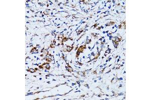 Immunohistochemistry of paraffin-embedded human uterine cancer using RARS antibody (ABIN5973728) at dilution of 1/100 (40x lens). (RARS 抗体)