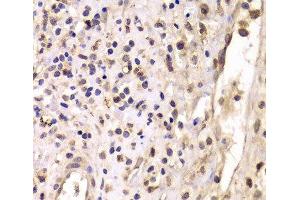 Immunohistochemistry of paraffin-embedded Human breast cancer using HDAC4 Polyclonal Antibody at dilution of 1:100 (40x lens). (HDAC4 抗体)