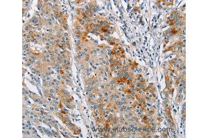 Immunohistochemistry of Human gastric cancer using BCL10 Polyclonal Antibody at dilution of 1:40 (BCL10 抗体)