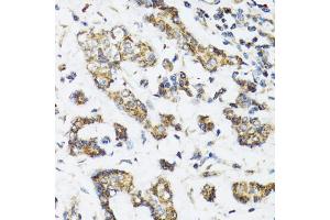 Immunohistochemistry of paraffin-embedded human breast cancer using DHRS2 antibody (ABIN5973846) at dilution of 1/100 (40x lens). (DHRS2 抗体)
