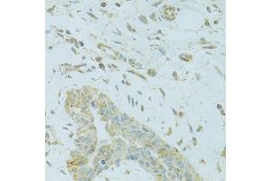 Immunohistochemistry of paraffin-embedded human breast cancer using MTFP1 antibody (ABIN5975088) at dilution of 1/100 (40x lens). (Mtfp1 抗体)