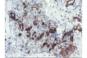 Immunohistochemical staining of paraffin-embedded Adenocarcinoma of Human breast tissue using anti-SERPINB2 mouse monoclonal antibody. (SERPINB2 抗体)