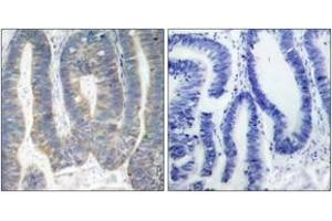 Immunohistochemistry analysis of paraffin-embedded human colon carcinoma, using PKR (Ab-451) Antibody. (EIF2AK2 抗体  (AA 418-467))