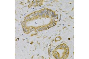 Immunohistochemistry of paraffin-embedded human liver cancer using EIF4B Antibody (ABIN5973134) at dilution of 1/100 (40x lens). (EIF4B 抗体)