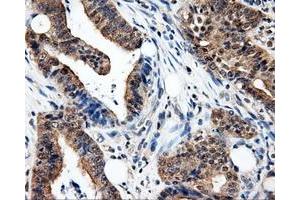 Immunohistochemical staining of paraffin-embedded Adenocarcinoma of colon tissue using anti-PSMC3 mouse monoclonal antibody. (PSMC3 抗体)