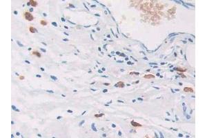 DAB staining on IHC-P; Samples: Human Colorectal cancer Tissue (CEACAM7 抗体  (AA 147-231))