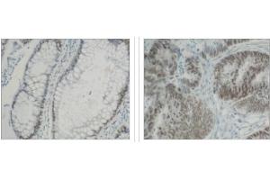 Immunohistochemical staining of  normal colon (left) and colon carninoma (center) using hnRNP-K antibody . (HNRNPK 抗体  (C-Term))