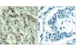 Immunohistochemical analysis of paraffin-embedded human breast carcinoma tissue using AuroraA (phospho-Thr288) Antibody (E011519). (Aurora A 抗体  (pThr288))