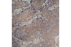 Immunohistochemistry of paraffin-embedded human breast carcinoma using Phospho-MYL12A-S18 antibody (ABIN2988196). (MYL12A 抗体  (pSer18))