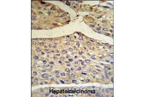 BF Antibody IHC analysis in formalin fixed and paraffin embedded human hepatocarcinoma tissue followed by peroxidase conjugation of the secondary antibody and DAB staining. (Complement Factor B 抗体  (AA 395-422))