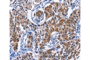 Immunohistochemistry of Human breast cancer using MYH1 Polyclonal Antibody at dilution of 1:40 (MYH1 抗体)