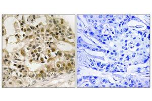 Immunohistochemistry analysis of paraffin-embedded human breast carcinoma tissue using Myb (Phospho-Ser532) antibody. (MYB 抗体  (pSer532))