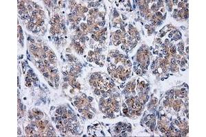 Immunohistochemical staining of paraffin-embedded Carcinoma of liver tissue using anti-BTK mouse monoclonal antibody. (BTK 抗体)