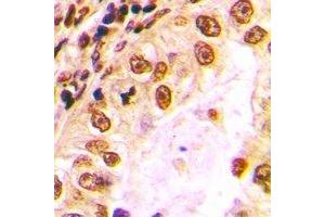 Immunohistochemical analysis of Nibrin staining in human lung cancer formalin fixed paraffin embedded tissue section. (Nibrin 抗体)