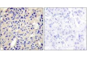 Immunohistochemistry analysis of paraffin-embedded human breast carcinoma tissue, using Collagen V alpha2 Antibody. (COL5A2 抗体  (AA 1-50))