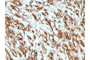 Formalin-fixed, paraffin-embedded human rhabdomyosarcoma stained with pan Muscle Actin antibody (MSA/953) (Pan Muscle Actin 抗体)