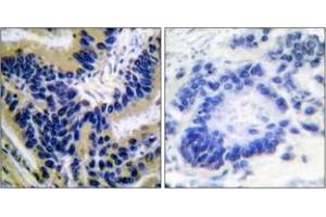 Immunohistochemistry analysis of paraffin-embedded human lung carcinoma, using Caspase 3 (Cleaved-Asp175) Antibody. (Caspase 3 抗体  (Cleaved-Asp175))