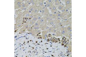 Immunohistochemistry of paraffin-embedded human liver injury using S100A12 antibody (ABIN5973068) at dilution of 1/100 (40x lens). (S100A12 抗体)