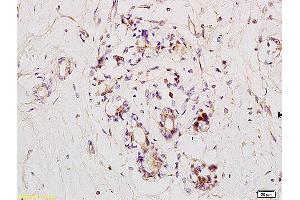 Formalin-fixed and paraffin embedded human breast carcinoma labeled with Anti RNF31/HOIP Polyclonal Antibody, Unconjugated (ABIN1387804) at 1:200 followed by conjugation to the secondary antibody and DAB staining. (RNF31 抗体)