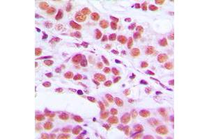 Immunohistochemical analysis of Histone H3 (pS10) staining in human breast cancer formalin fixed paraffin embedded tissue section. (Histone 3 抗体  (pSer10))