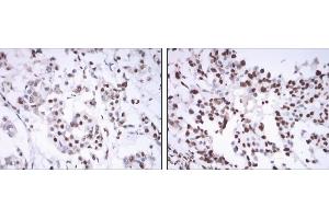 Immunohistochemical analysis of paraffin-embedded mammary cancer tissues using ESR1 mouse mAb with DAB staining. (Estrogen Receptor alpha 抗体)