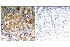 Immunohistochemical analysis of paraffin-embedded human lung carcinoma tissue using PKCζ (Phospho-Thr410) antibody (E011314). (PKC zeta 抗体  (pThr410))