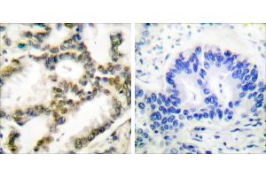 Peptide - +Immunohistochemical analysis of paraffin-embedded human lung carcinoma tissue using DJ-1 antibody (#C0172). (PARK7/DJ1 抗体)