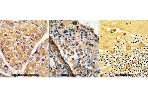 Formalin-fixed and paraffin-embedded (from Left to Right) human hepatocarcinoma, lung carcinoma and cerebellum reacted with GARP Antibody (Center), which was peroxidase-conjugated to the secondary antibody, followed by DAB staining. (LRRC32 抗体  (AA 240-269))