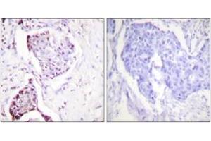 Immunohistochemistry analysis of paraffin-embedded human breast carcinoma tissue, using Ubiquitin Antibody. (Ubiquitin 抗体  (AA 40-89))