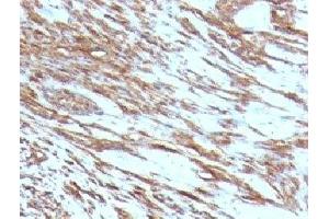 Formalin-fixed, paraffin-embedded human leiomyosarcoma stained with pan Muscle Actin antibody (MSA/953) (Pan Muscle Actin 抗体)