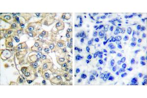 Peptide - +Immunohistochemical analysis of paraffin-embedded human breast carcinoma tissue using FGFR1 Oncogene Partner antibody (#C0190). (FGFR1OP 抗体)