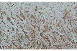 Immunohistochemistry of paraffin-embedded Human breast carcinoma tissue using HDAC1 Monoclonal Antibody at dilution of 1:200. (HDAC1 抗体)