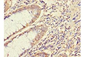 Immunohistochemistry of paraffin-embedded human colon cancer using ABIN7145091 at dilution of 1:100 (ATG5 抗体  (AA 5-272))