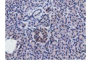 Immunohistochemical staining of paraffin-embedded Adenocarcinoma of Human breast tissue using anti-NT5DC1 mouse monoclonal antibody. (NT5DC1 抗体)