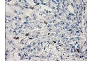 Immunohistochemical staining of paraffin-embedded Carcinoma of Human bladder tissue using anti-TP53 mouse monoclonal antibody. (p53 抗体)