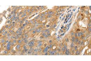 Immunohistochemistry of paraffin-embedded Human ovarian cancer using CALR Polyclonal Antibody at dilution of 1:50 (Calreticulin 抗体)