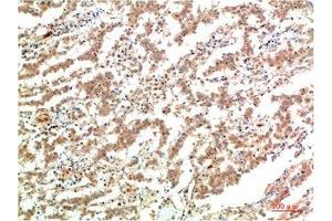 Immunohistochemical analysis of paraffin-embedded Human Lung Carcinoma Tissue using JAK2 Mouse mAb diluted at 1:200. (JAK2 抗体)