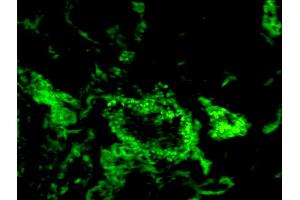 Formalin-fixed and paraffin-embedded human breast cancer labeled with Anti-CD150/SLAMF1 Polyclonal Antibody, Unconjugated (ABIN749468) 1:200, overnight at 4°C, The secondary antibody was Goat Anti-Rabbit IgG, FITC conjugated used at 1:200 dilution for 40 minutes at 37°C. (SLAMF1 抗体  (AA 231-335))