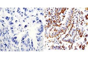 Immunohistochemistry analysis of Connexin 43 showing staining in the membrane of paraffin-embedded human lung adenocarcinoma (right) compared to a negative control without primary antibody (left). (Connexin 43/GJA1 抗体  (C-Term))