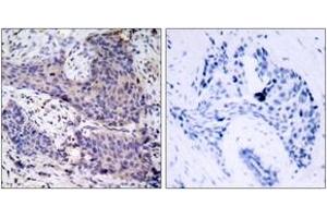 Immunohistochemistry analysis of paraffin-embedded human breast carcinoma tissue, using BAD (Ab-136) Antibody. (BAD 抗体  (AA 102-151))