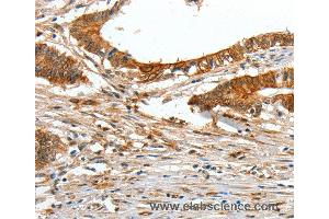 Immunohistochemistry of Human lung cancer using COL1A2 Polyclonal Antibody at dilution of 1:70 (COL1A2 抗体)