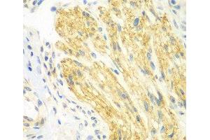 Immunohistochemistry of paraffin-embedded Human gastric cancer using PTK6 Polyclonal Antibody at dilution of 1:100 (40x lens). (PTK6 抗体)