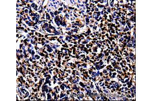 Immunohistochemistry of Human stomach cancer  using S100A4 Polyclonal Antibody at dilution of 1:100 (s100a4 抗体)