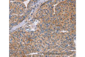 Immunohistochemistry of Human colon cancer using CDC7 Polyclonal Antibody at dilution of 1:70 (CDC7 抗体)