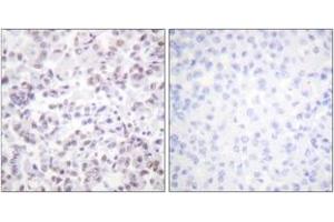 Immunohistochemistry analysis of paraffin-embedded human breast carcinoma tissue, using Histone H2B (Ab-12) Antibody. (Histone H2B 抗体  (AA 10-59))