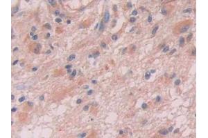 DAB staining on IHC-P; Samples: Human Glioma Tissue (Anion/Sugar Transporter 抗体  (AA 146-405))