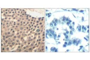 Immunohistochemical analysis of paraffin-embedded human lung carcinoma tissue using HDAC4/HDAC5/HDAC9 (Ab-246/259/220) Antibody (E021517). (HDAC4/HDAC5/HDAC9 抗体)