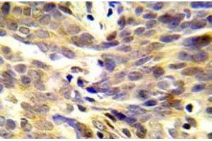 Immunohistochemistry (IHC) analyzes of p-BRCA1 antibody in paraffin-embedded human lung adenocarcinoma tissue. (BRCA1 抗体  (pSer1423))