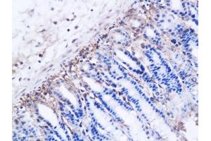 Formalin-fixed and paraffin embedded ovarian cancer xenograft labeled with Anti-DBC2 receptor Polyclonal Antibody, Unconjugated  followed by conjugation to the secondary antibody and DAB staining (RHOBTB2 抗体  (AA 631-727))
