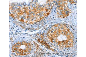 Immunohistochemistry of Human thyroid cancer using AIP Polyclonal Antibody at dilution of 1:80 (AIP 抗体)
